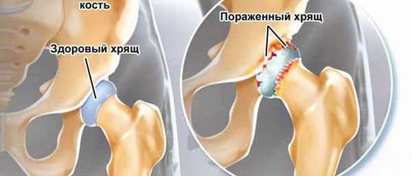 Безоперационное лечение коксартроза тазобедренного сустава